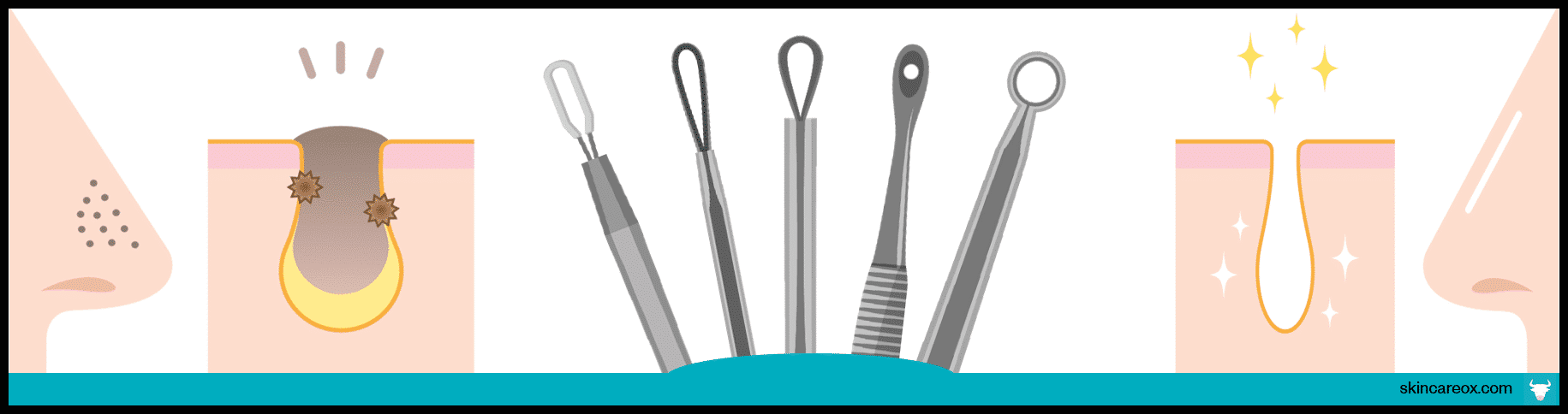 Blackhead Removal Tools & Treatments: The Ultimate Guide - Skin Care Ox